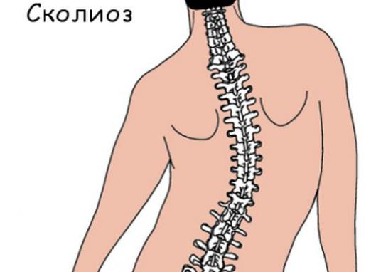 Skolyoz nedir?